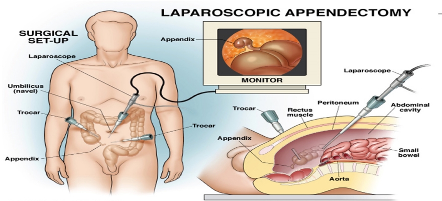 appendix-surgery