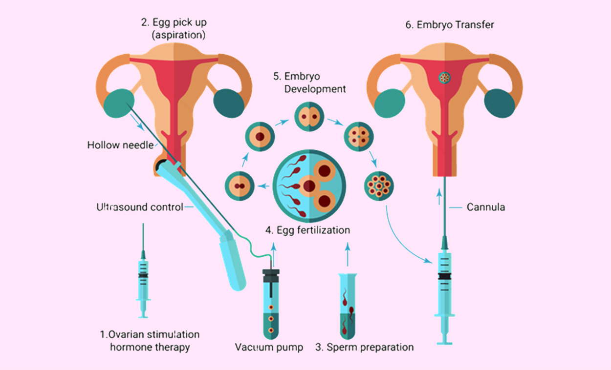 In Vitro Fertilization (IVF)